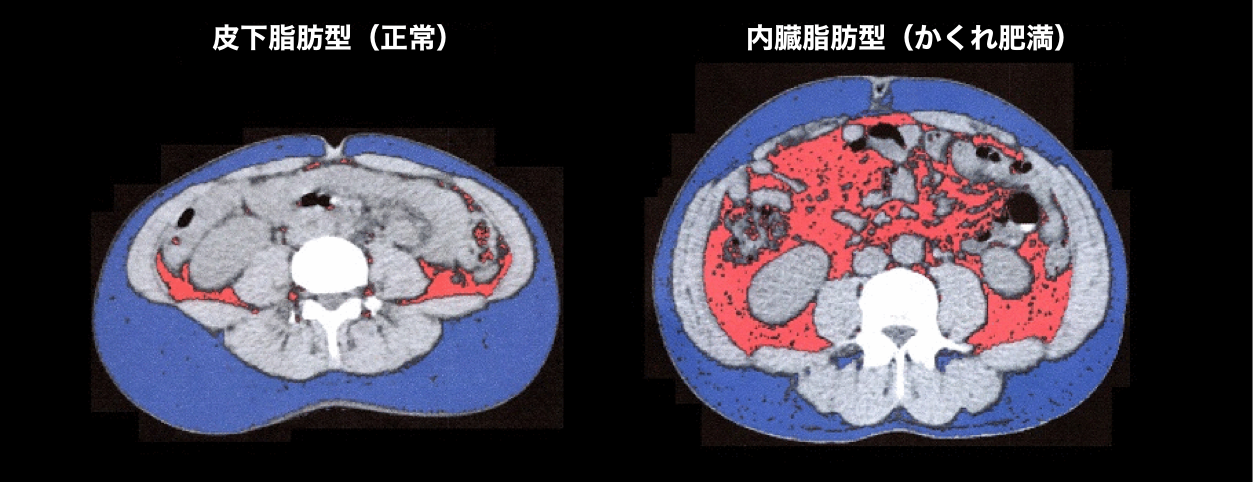 CT体脂肪検査