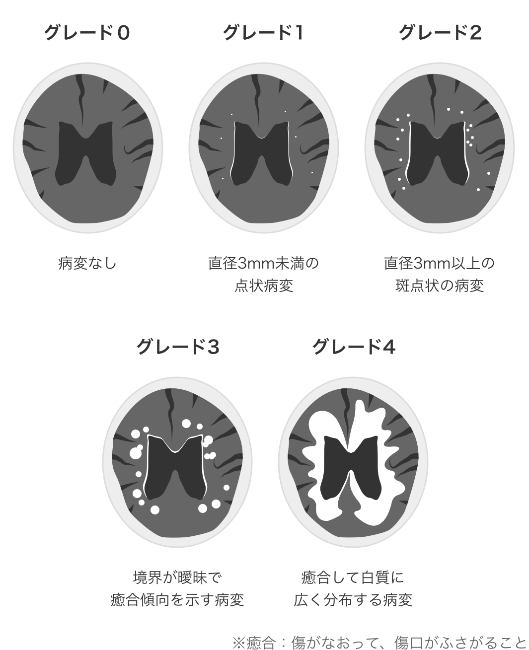 大脳白質病変ってなに？ 病変の仕組みや、種類・グレードについて解説 スマート脳ドック