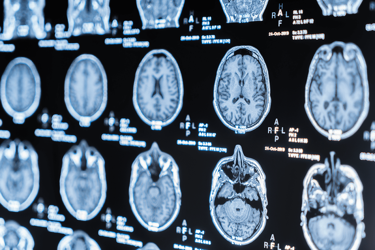 頭部mri検査とは 発見できる病気や費用相場 検査を受けるメリットについて解説 スマート脳ドック 健康コラム