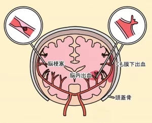 脳血管性認知症の原因