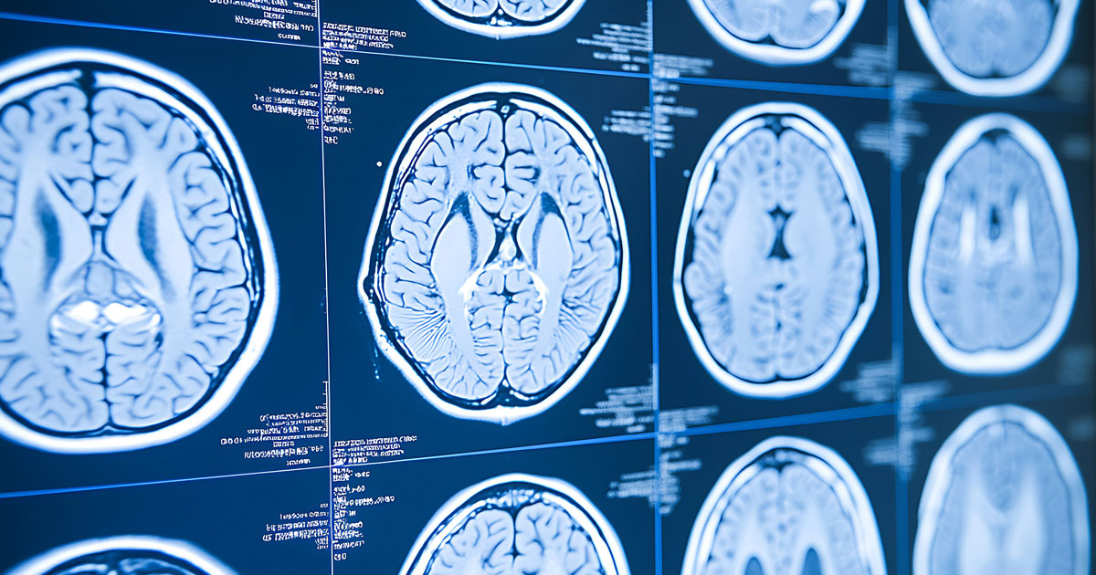 認知症とMRI：診断に役立つ画像検査のすべて