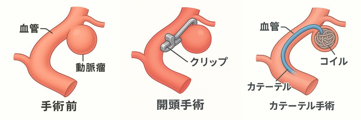 くも膜下出血の発症 ― 脳動脈瘤が関与した可能性のある事例